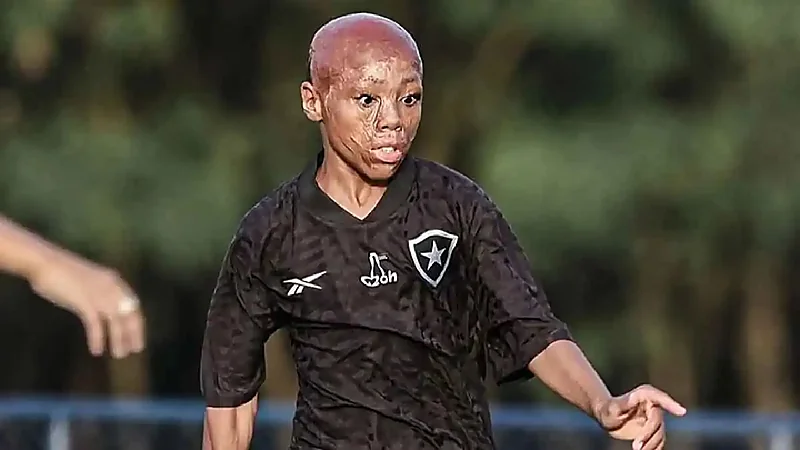 قصة برناردو لوبيز: من الحروق المروعة إلى الملاعب البرازيلية